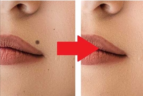 خال های بدن و صورت خود را چگونه ازبین ببریم؟ 